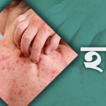 ২৪ ঘণ্টায় হাম সন্দেহে ৮ শিশুর মৃত্যু, আক্রান্ত প্রায় ৯৪৫ pinews24