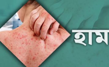 ২৪ ঘণ্টায় হাম সন্দেহে ৮ শিশুর মৃত্যু, আক্রান্ত প্রায় ৯৪৫ pinews24